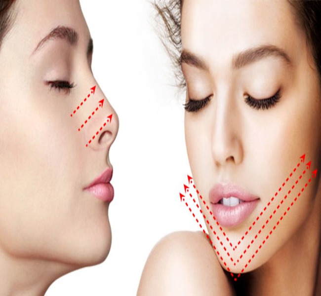 Căng chỉ collagen nâng cơ mặt