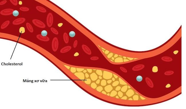 Cholesterol cao hay thấp ảnh hưởng gì đến sức khỏe?