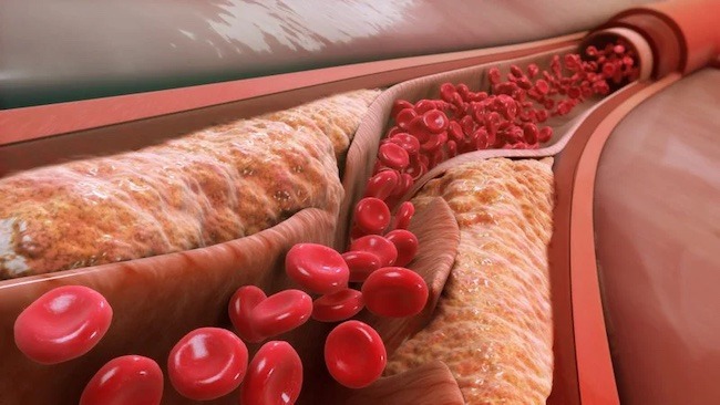 Cholesterol toàn phần trong máu là gì?